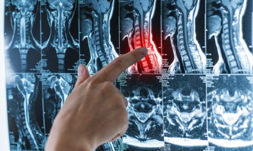 series-mri-images-spine-spinal-cord-with-red-pain-point-osteochondrosis-scoliosis-hands-with-magnetic-resonance-imaging-scan-concept-768x512