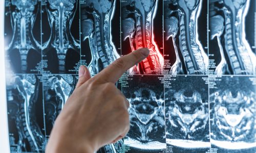 series-mri-images-spine-spinal-cord-with-red-pain-point-osteochondrosis-scoliosis-hands-with-magnetic-resonance-imaging-scan-concept